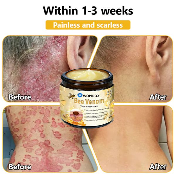 Bee Venom Skin Treatment Cream (AAD Recommended👨‍⚕️)