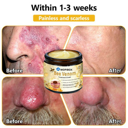 Bee Venom Skin Treatment Cream (AAD Recommended👨‍⚕️)